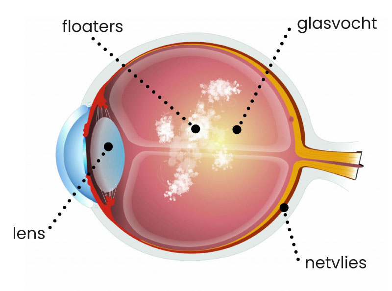 Een tekening van het oog, waarin floaters aanwezig zijn.