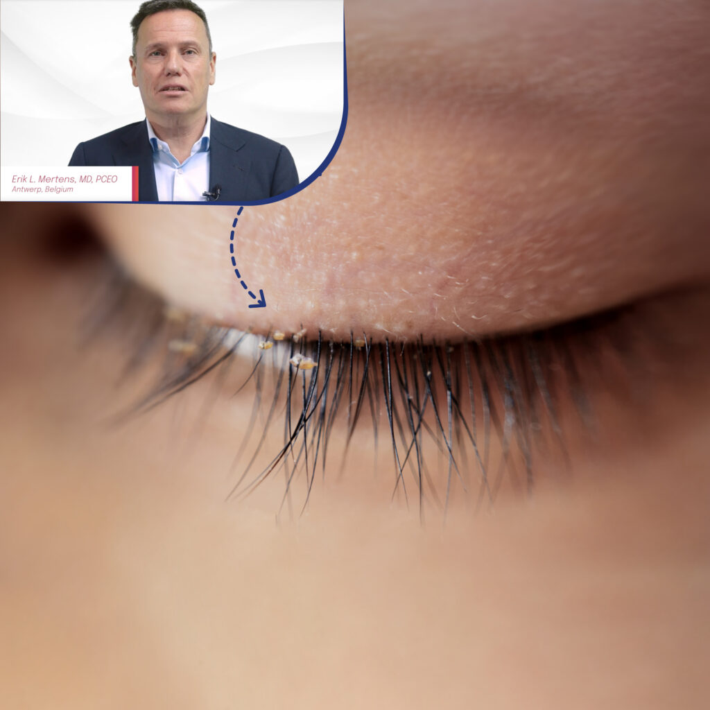 Demodex blepharitis