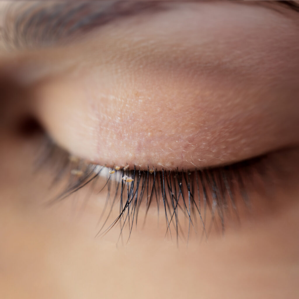 demodex blepharitis bij jonge vrouw